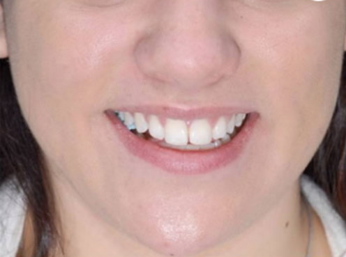 image comparison after